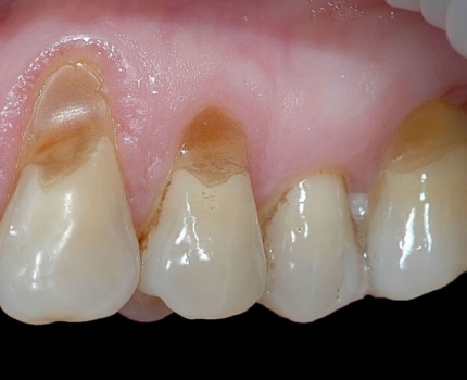 Некариозные поражения зубов