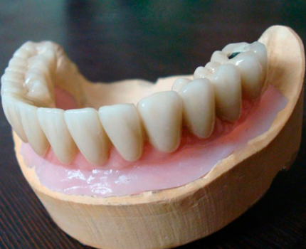 All-on-4 - восстановление зубов на имплантатах