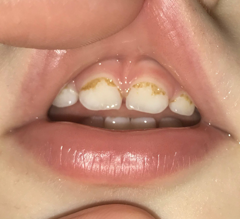 кариес молочных зубов