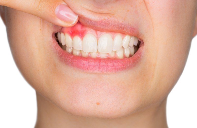 Болят десны. Причины и методы лечения