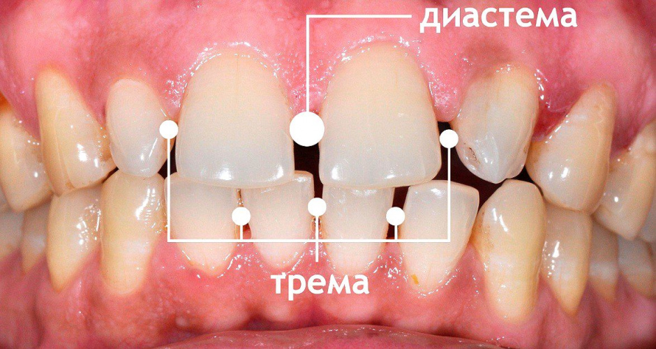 Диастема или щели между зубами: как их убрать